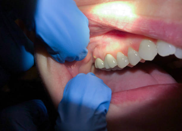 Best Urgent Care for Lost Fillings or Crowns in Palmyra, IN